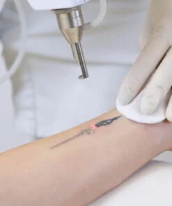 1 Sesión Eliminación de tatuajes zona pequeña